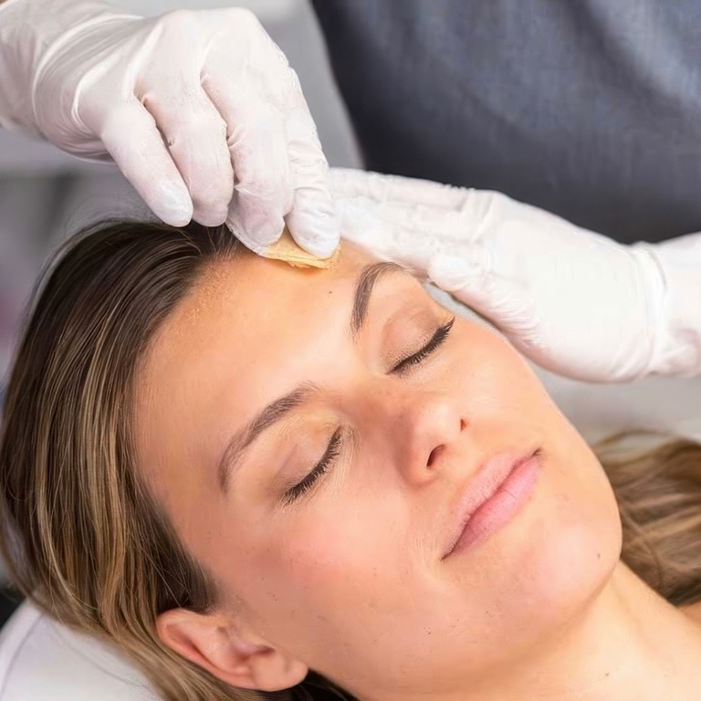 ViPeel Chemical Peel
